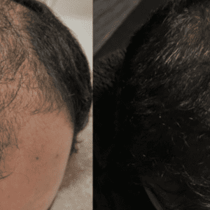 implante de pelo de 2000 unidades