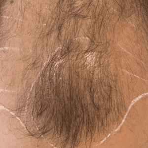 implante de pelo de 3000 unidades