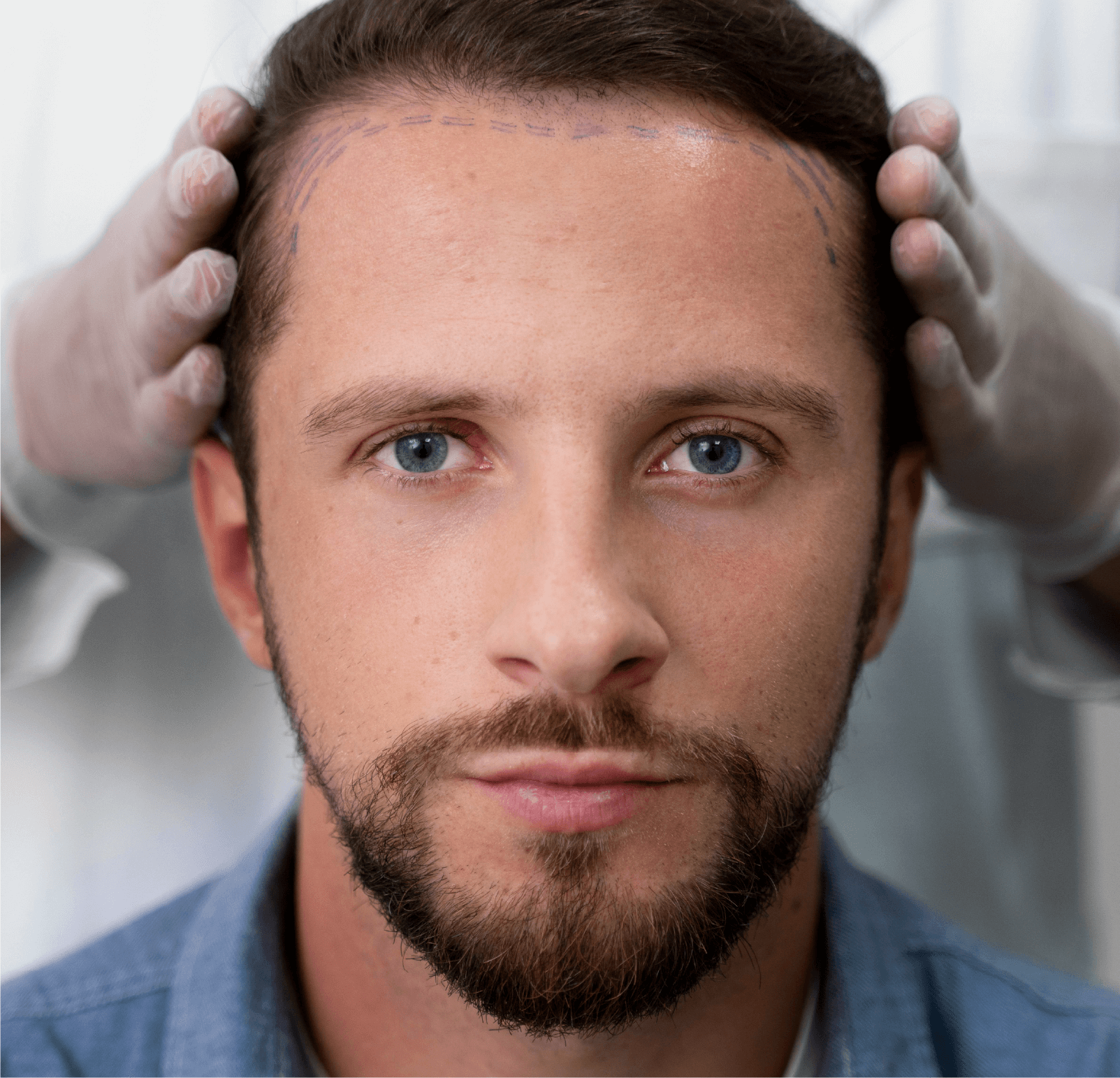 Implante de pelo