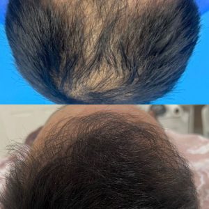 implante de pelo de 3500 unidades