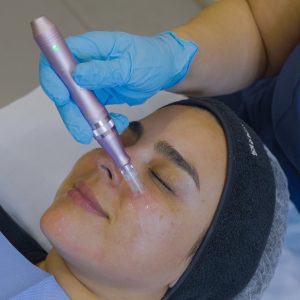 Peeling Retinoico 4% para acné